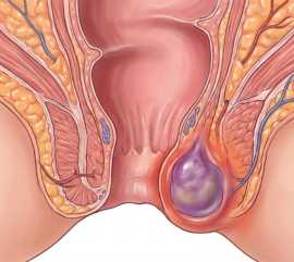 Abscesso Anal