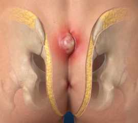 Cisto Pilonidal