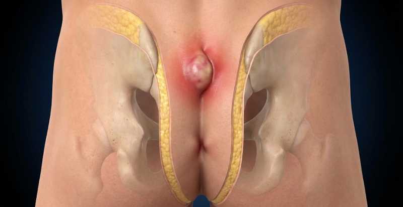 Cisto Pilonidal