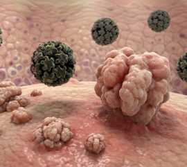 Condilomas e HPV