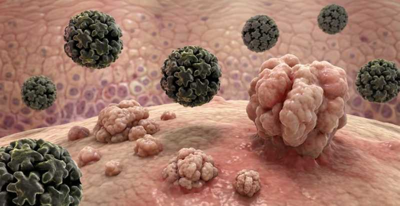 Condilomas e HPV