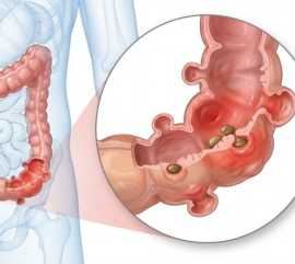 Doença Diverticular