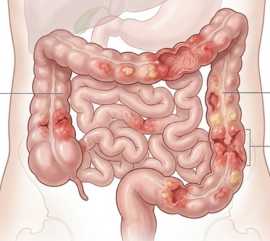 Doença de Crohn