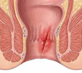 Fissura Anal