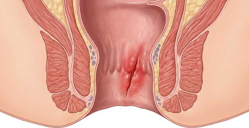 Fissura Anal