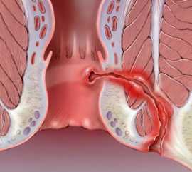 Fístula Anal
