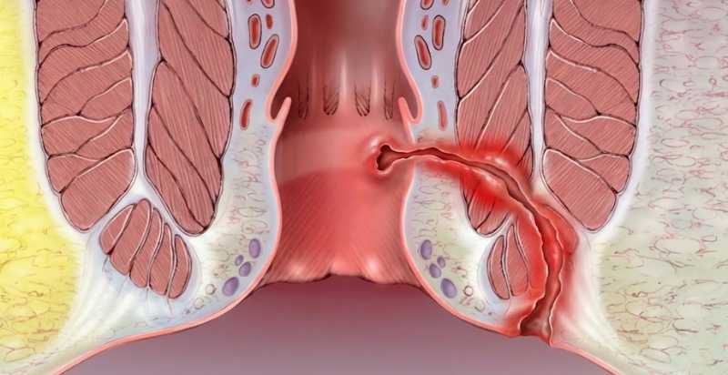 Fístula Anal