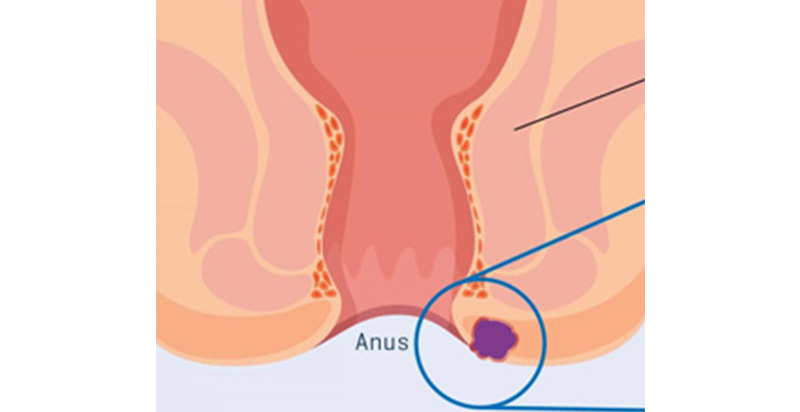 Abscesso Anal