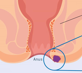 Abscesso Anal