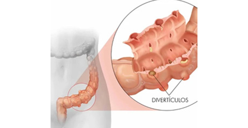 Doença Diverticular