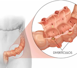 Doença Diverticular