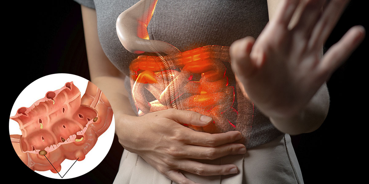 Diverticulite e Diverticulose  são a mesma coisa?