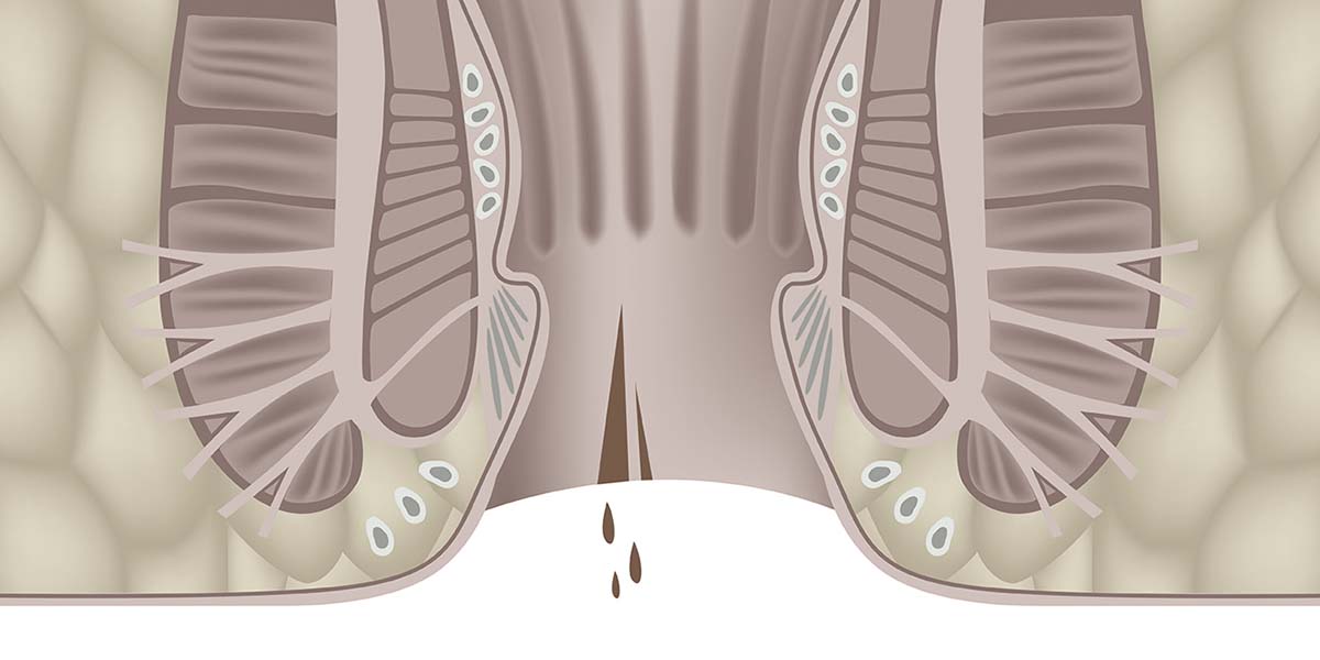 O que é uma fissura anal?
