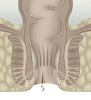 O que é uma fissura anal?