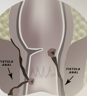 O quê é uma fistula anal?