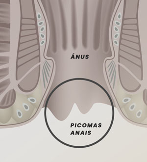 Plicomas Anais. O quê são? Qual o tratamento recomendado?