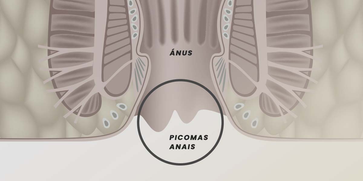 Plicomas Anais. O quê são? Qual o tratamento recomendado?