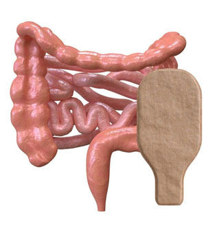 Você sabe o que é a colostomia?