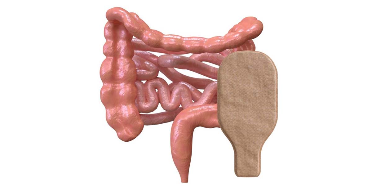 Você sabe o que é a colostomia?