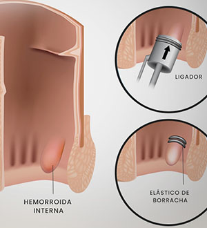 Ligadura elástica para hemorroidas