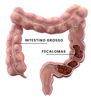 O que é um fecaloma? Conheça as causas e o tratamento