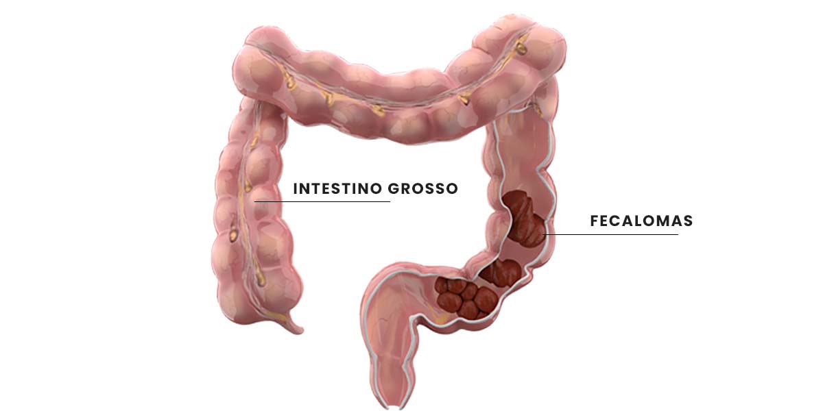 O que é um fecaloma? Conheça as causas e o tratamento
