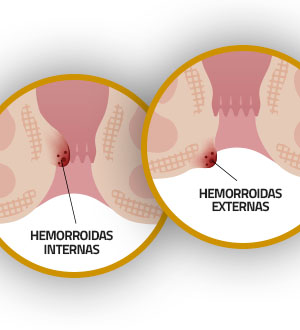 As hemorroidas podem ser externas ou internas