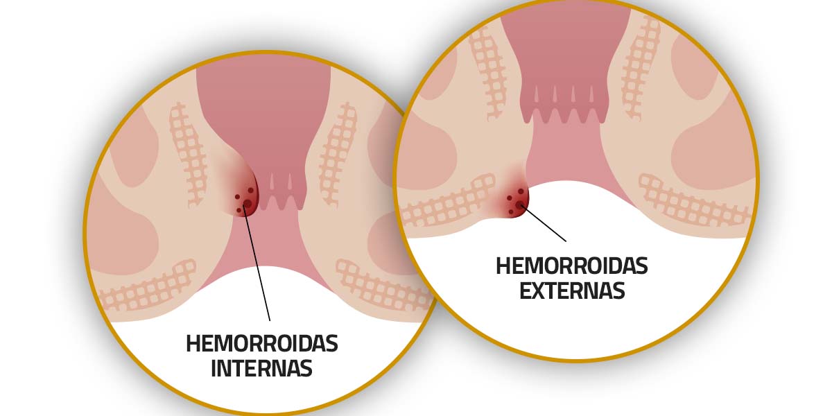 As hemorroidas podem ser externas ou internas