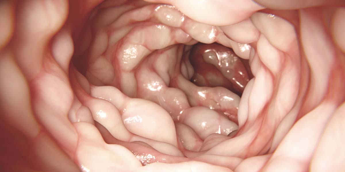 Doença de Crohn Perianal