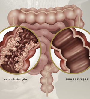 Obstrução Intestinal