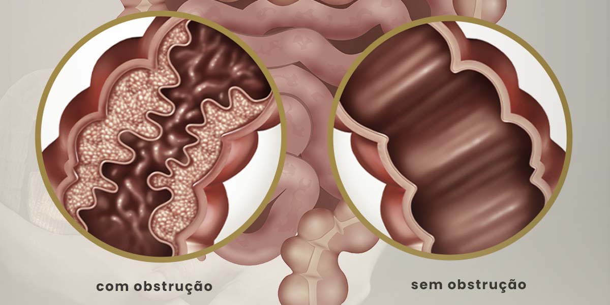 Obstrução Intestinal