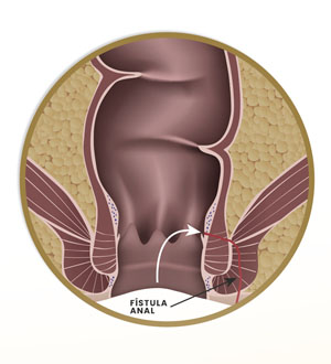 A Fístula Anal pode causar um Câncer Anal?