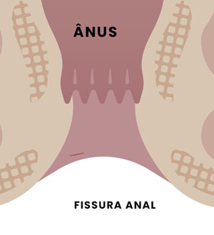 Fissuras Anais Atípicas: O que são e como tratá-las?