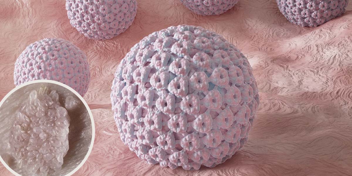 Condiloma acumulado e HPV lesões e verrugas que podem aparecer ao redor do ânus