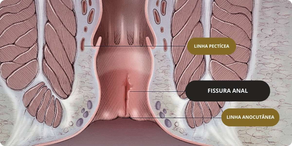 As principais causas das Fissuras Anais