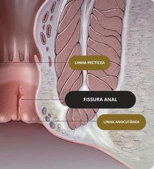 As principais causas das Fissuras Anais
