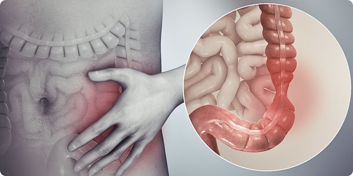 Síndrome do Intestino Irritável (SII): O que você precisa saber