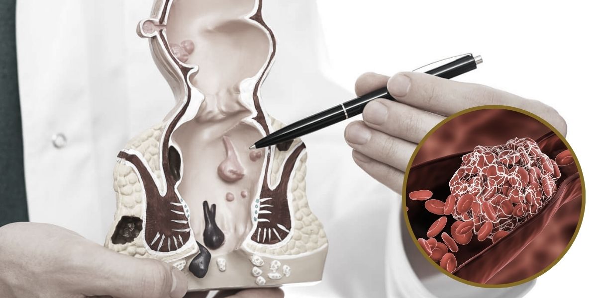 Trombose Hemorroidária: O que é e como tratar?