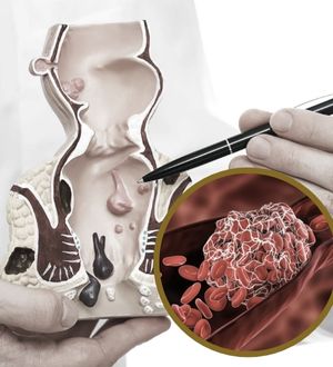 Trombose Hemorroidária: O que é e como tratar?