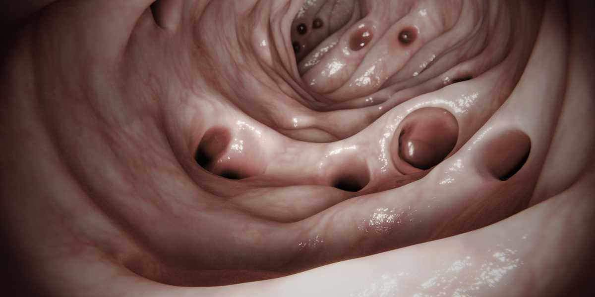 Você sabe a diferença entre Diverticulose, Doença Diverticular e Diverticulite?