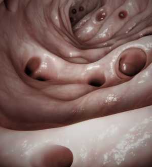 Você sabe a diferença entre Diverticulose, Doença Diverticular e Diverticulite?