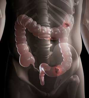Câncer de Intestino: Fatores de Risco e Prevenção