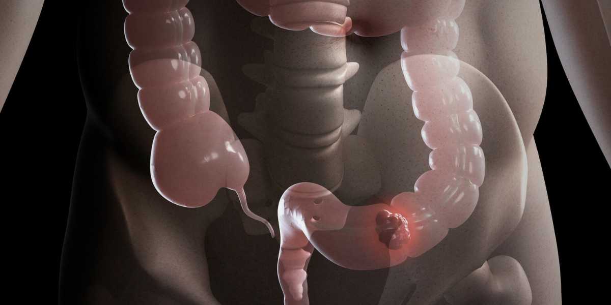 Câncer de Intestino: Fatores de Risco e Prevenção
