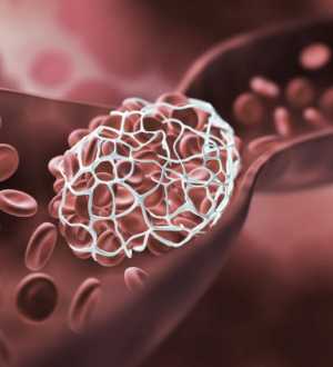 Trombose Hemorroidária: o Que É, Sintomas e Como Tratar
