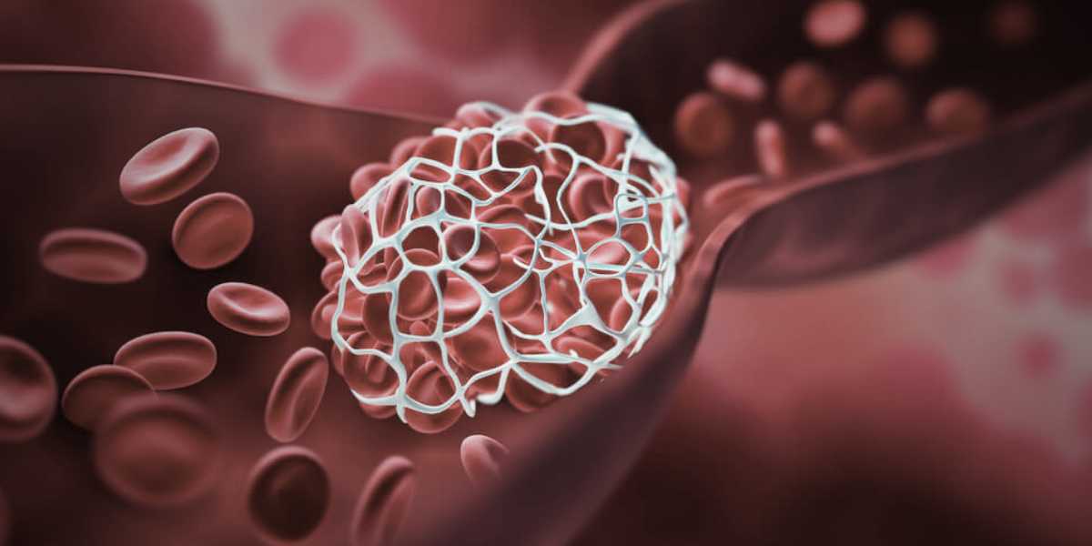 Trombose Hemorroidária: o Que É, Sintomas e Como Tratar