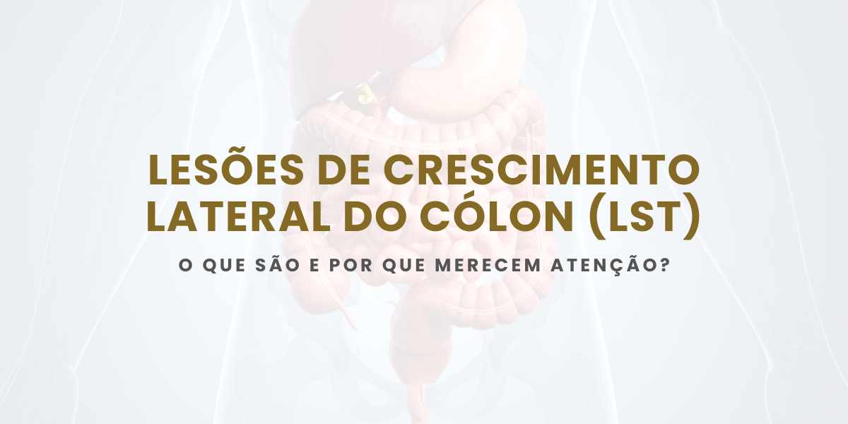 Lesões de crescimento lateral do cólon (lst): o que são e como tratar