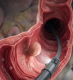 Pólipo é câncer? Descubra a verdade sobre a prevenção e a importância da colonoscopia